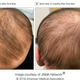 Imagen para el artículo titulado Un efecto secundario en un nuevo fármaco contra la dermatitis devuelve el pelo a una paciente con alopecia